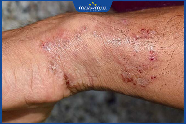 Bệnh nấm da tay: Nhận biết, nguyên nhân và cách điều trị 3 nấm da lan xuống cổ tay