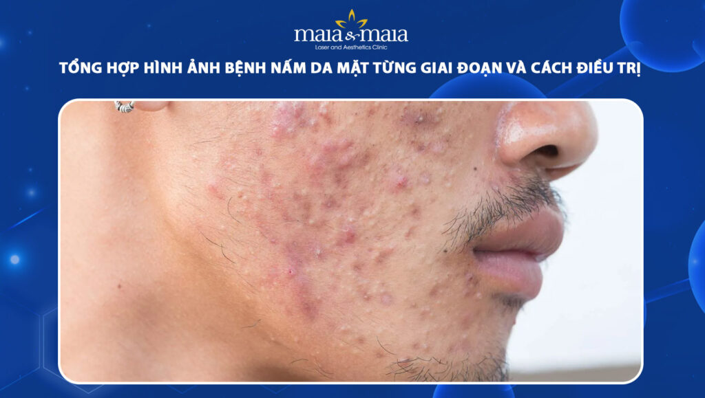 Hình ảnh bệnh nấm da mặt từng giai đoạn và cách nhận biết 1 hình ảnh bệnh nấm da mặt