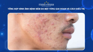 hình ảnh bệnh nấm da mặt