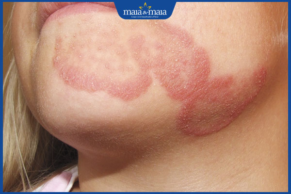 Hình ảnh bệnh nấm da mặt từng giai đoạn và cách nhận biết 3 nấm da mặt giai đoạn 2