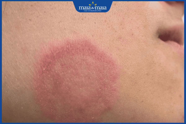 Hình ảnh bệnh nấm da mặt từng giai đoạn và cách nhận biết 2 nấm da mặt giai đoạn đầu