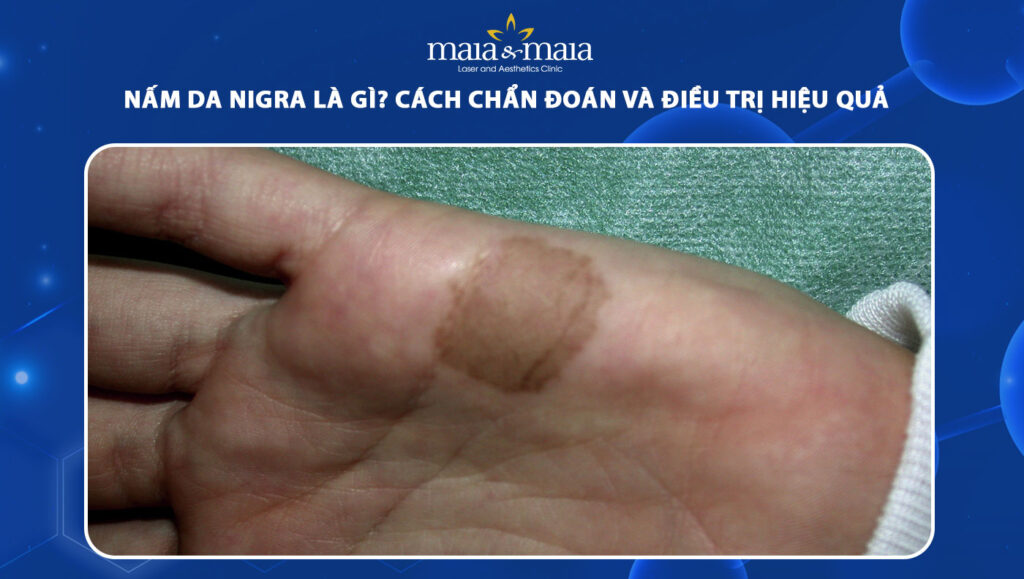 Nấm da Nigra là gì? Cách chẩn đoán và điều trị hiệu quả 1 nấm da nigra