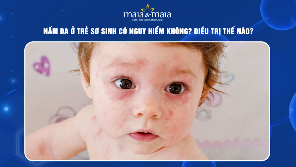 Nấm da ở trẻ sơ sinh