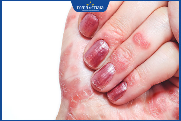 nấm do sơn móng tay