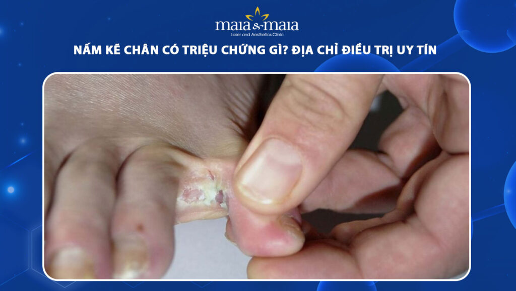 Triệu chứng nấm kẽ chân và các biện pháp điều trị hiệu quả 1 nấm kẽ chân