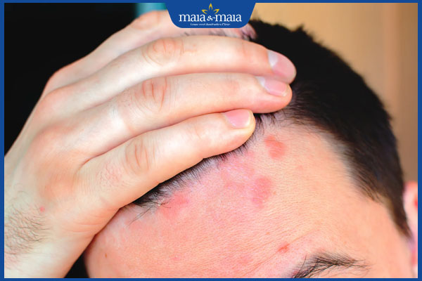 nấm lan xuống mặt