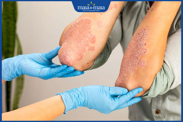 Nấm da có lây không? Đối tượng có nguy cơ cao bị lây nhiễm? 4 nam lay lan tren co the