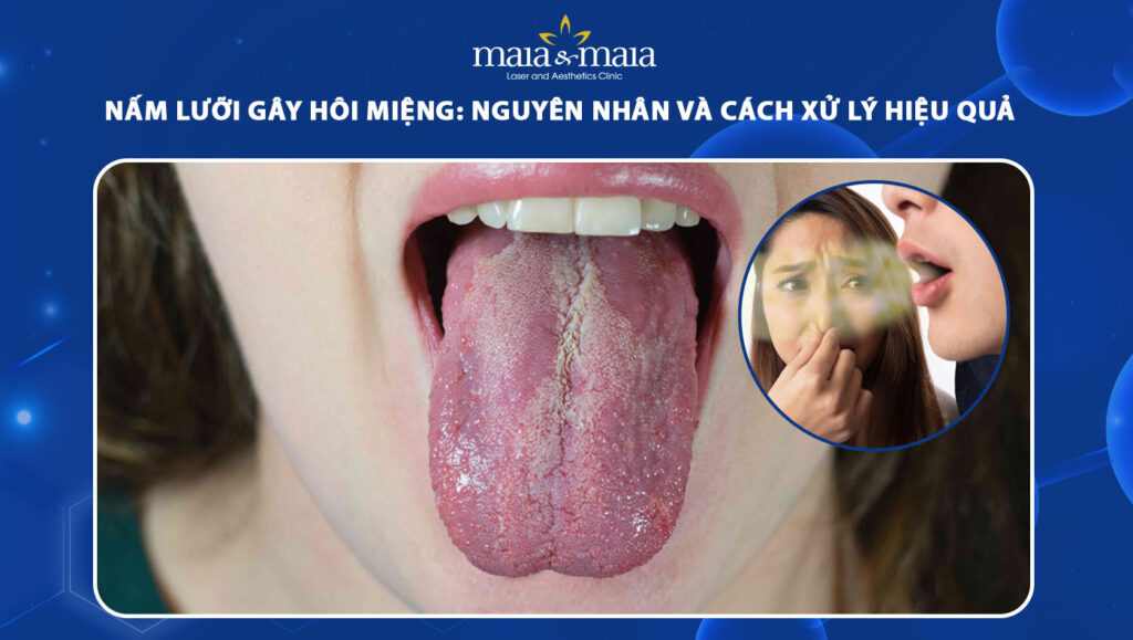 nấm lưỡi gây hôi miệng