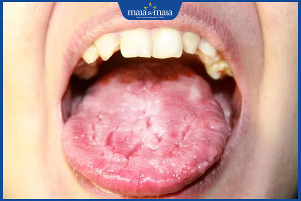 nấm lưỡi gây nứt nẻ