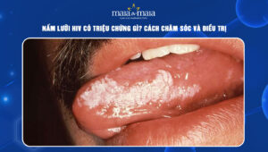 nấm lưỡi HIV
