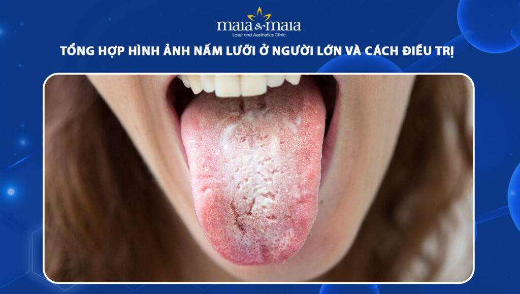 nấm lưỡi ở người lớn