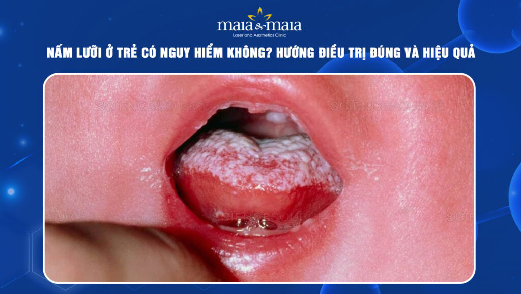 nấm lưỡi ở trẻ