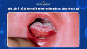 nấm lưỡi ở trẻ