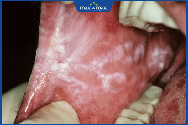 nấm miệng do bị hiv