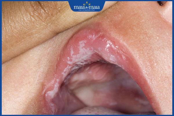 nấm miệng ở môi