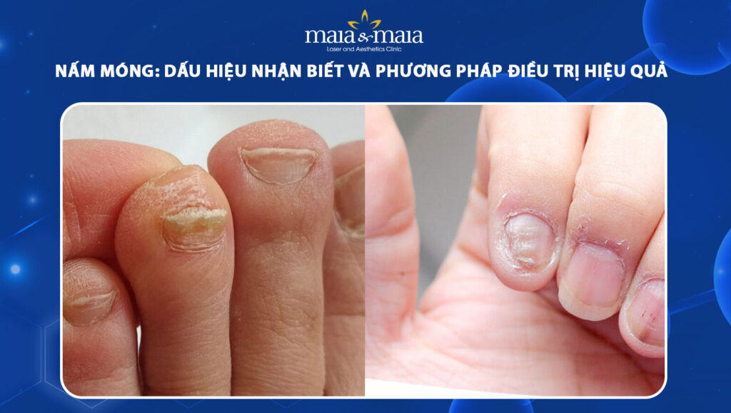 Nấm móng: Dấu hiệu nhận biết & phương pháp điều trị hiệu quả 1 nấm móng