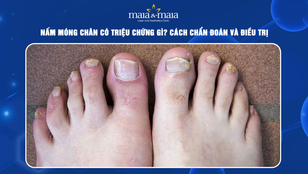 Nấm móng chân có triệu chứng gì? Cách chẩn đoán và điều trị 1 Nấm móng chân