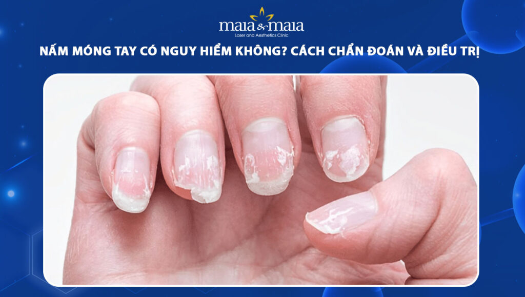 nấm móng tay