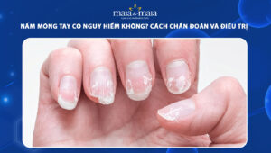 nấm móng tay