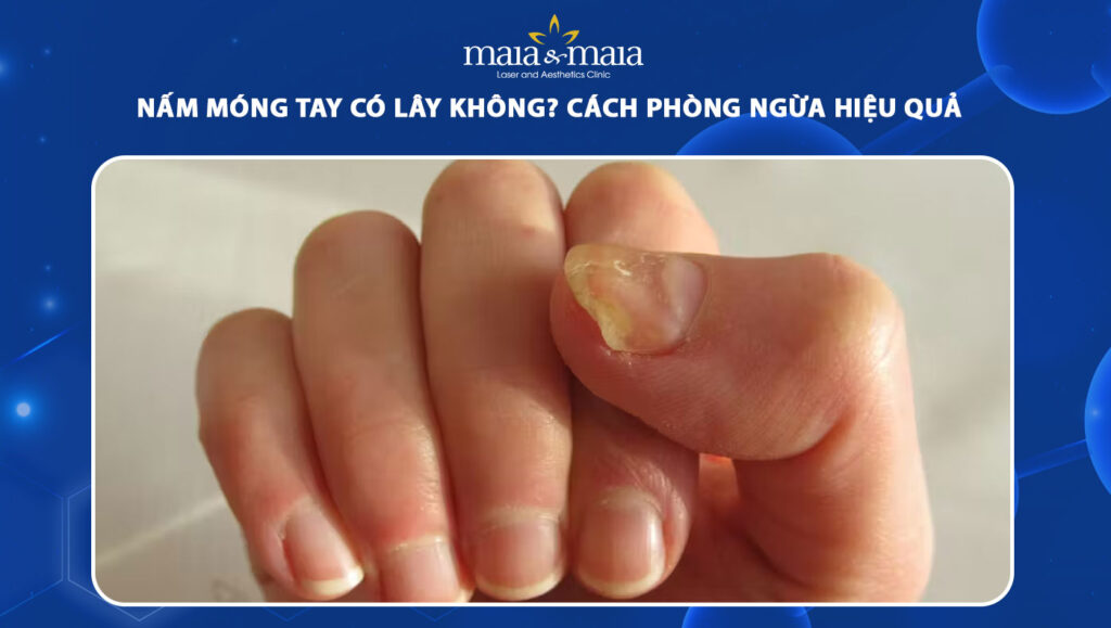 Nấm móng tay có lây không? Cách phòng ngừa hiệu quả 1 nấm móng tay có lây không