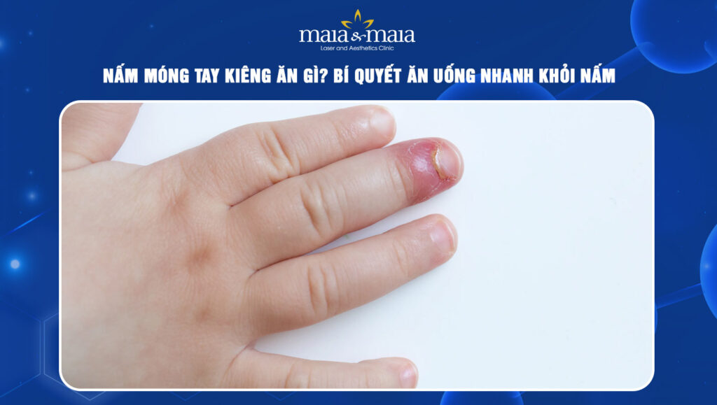 nấm móng tay ở trẻ em