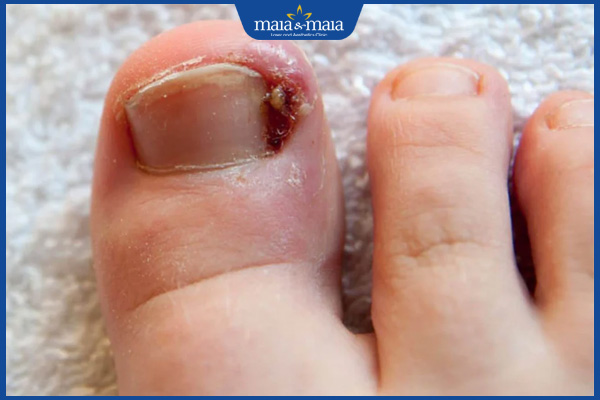 nấm móng viêm nhiễm