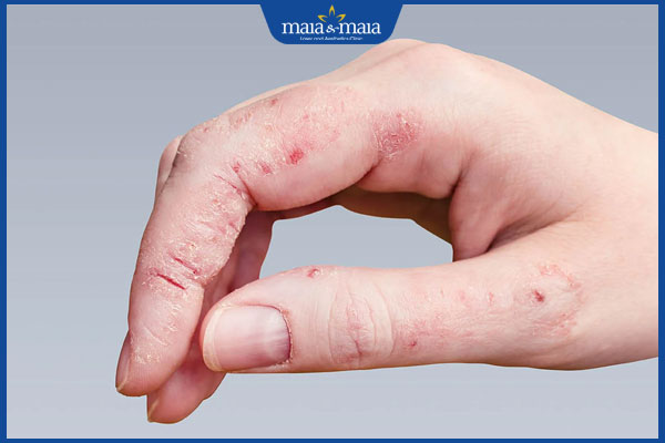 Bệnh nấm da tay: Nhận biết, nguyên nhân và cách điều trị 2 nấm ở các ngón tay