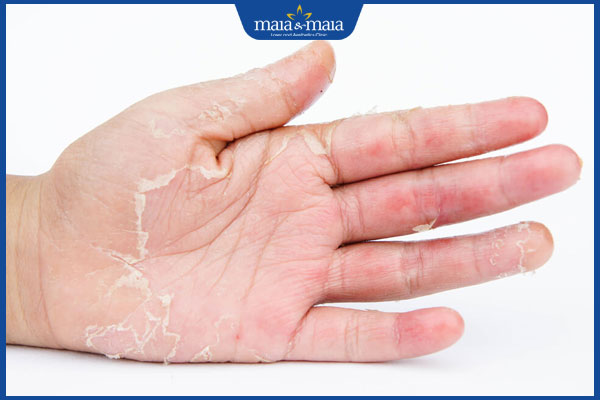 Bệnh nấm da tay: Nhận biết, nguyên nhân và cách điều trị 4 nấm ở tay gây bong tróc