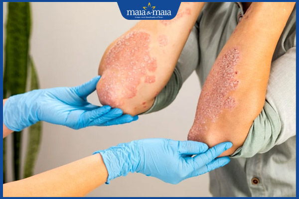 nấm toàn thân lan rộng