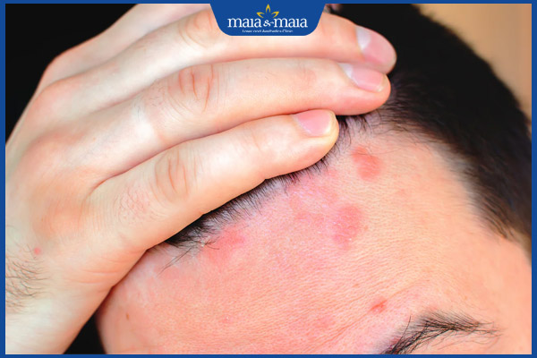 nấm tóc lan rộng