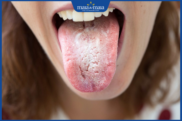 người lớn bị nấm ở lưỡi