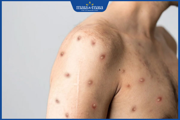 người nhiễm hiv