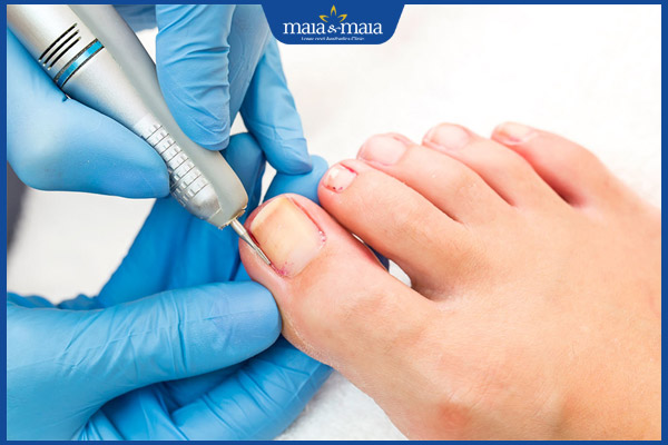 phẫu thuật chữa nấm móng