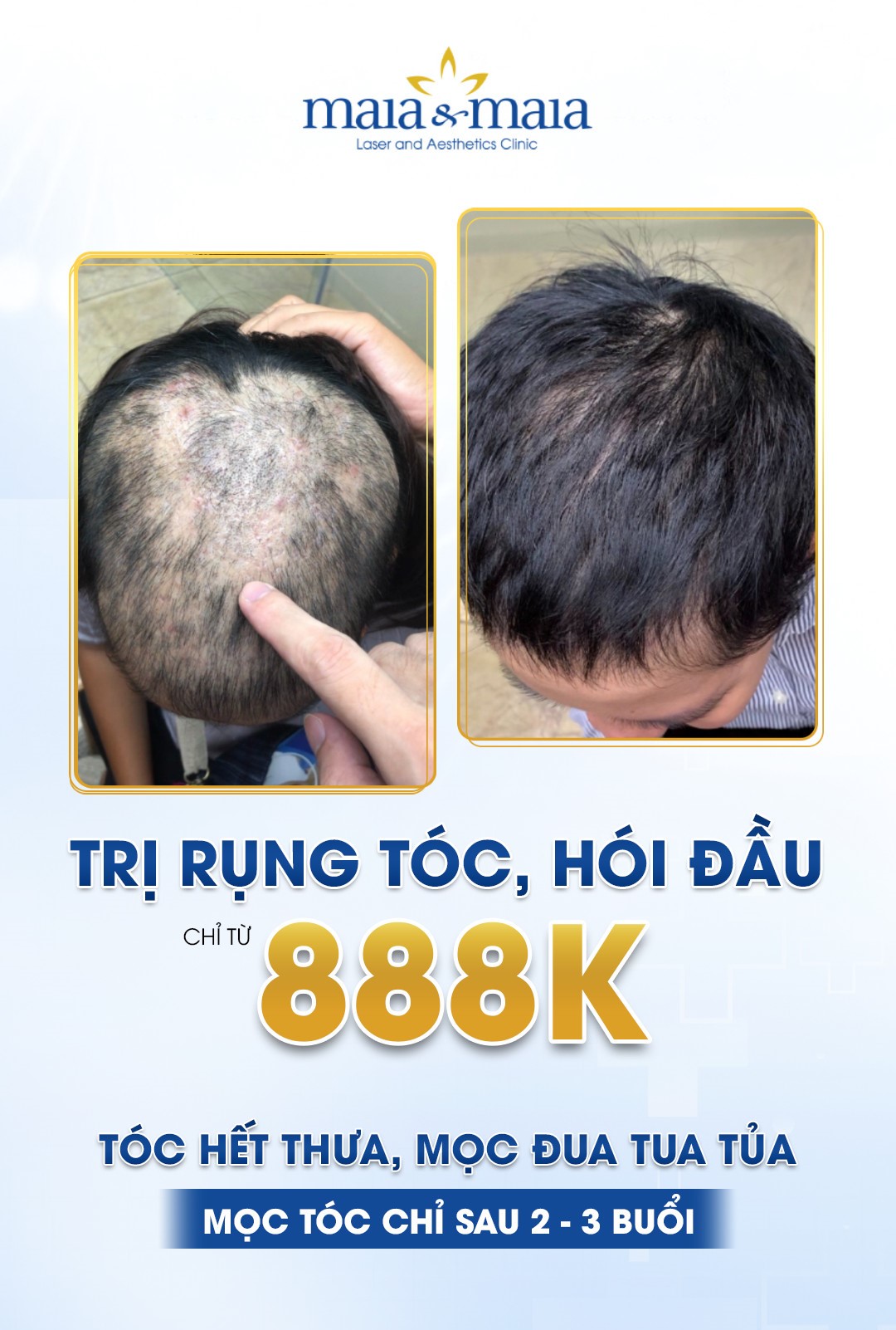 phong kham tri rung toc 1