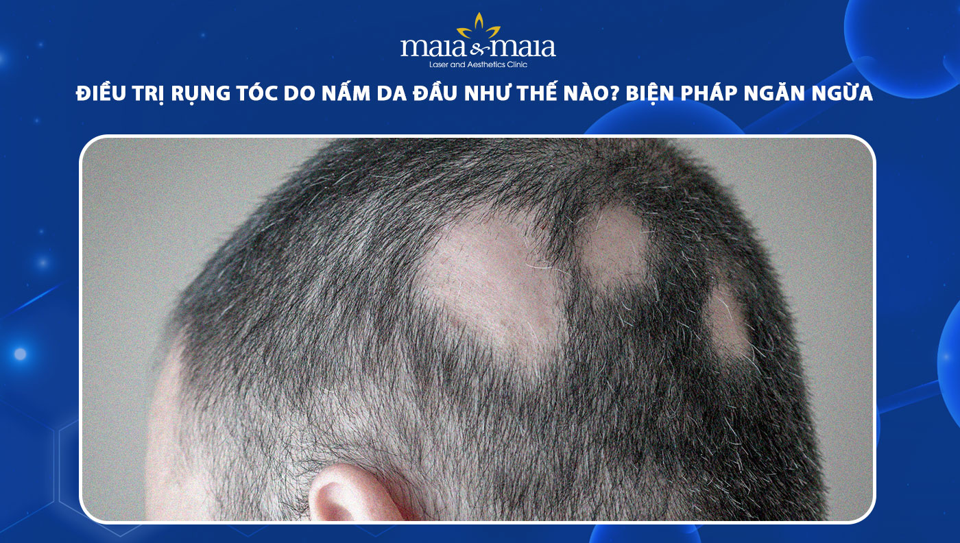 rụng tóc do nấm da đầu