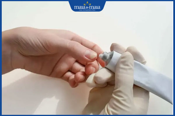 Nấm móng tay có lây không? Cách phòng ngừa hiệu quả 4 thuốc bôi trị nấm móng