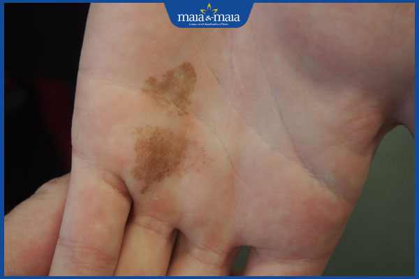 Nấm da Nigra là gì? Cách chẩn đoán và điều trị hiệu quả 2 tình trạng nấm da nigra