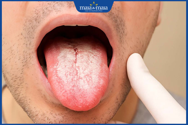 tình trạng nấm lưỡi