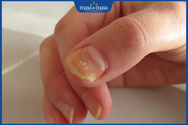 tình trạng nấm móng tay