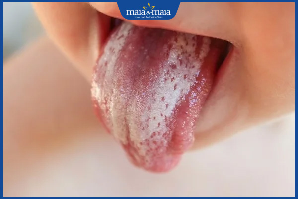 trẻ bị nấm candida miệng