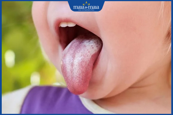 trẻ bị nấm lưỡi