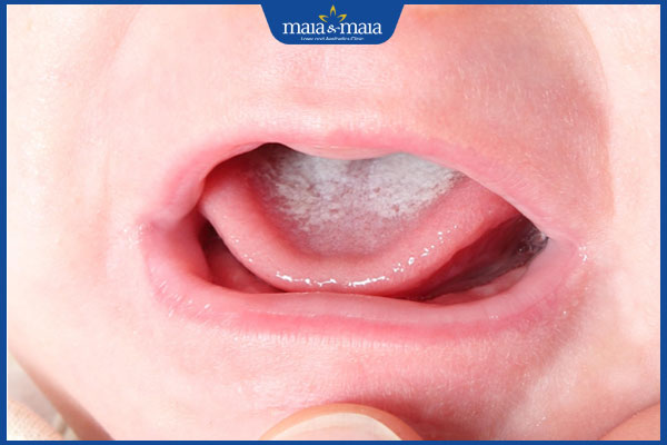 trẻ bị nấm miệng