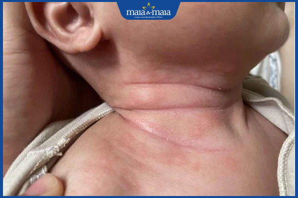 trẻ bị nấm ở rãnh cổ