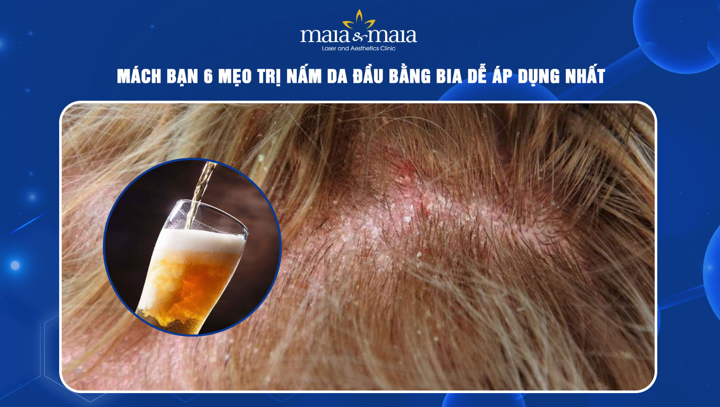 trị nấm da đầu bằng bia