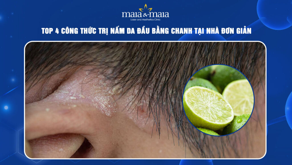 trị nấm da đầu bằng chanh