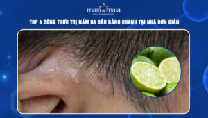 trị nấm da đầu bằng chanh
