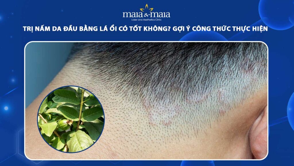 Trị nấm da đầu bằng lá ổi có tốt không? Gợi ý cách thực hiện 1 trị nấm da đầu bằng lá ổi