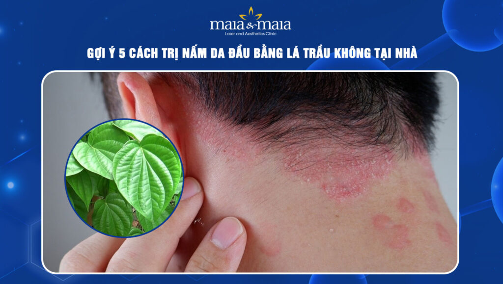 Gợi ý 5 cách trị nấm da đầu bằng lá trầu không tại nhà 1 trị nấm da đầu bằng lá trầu không