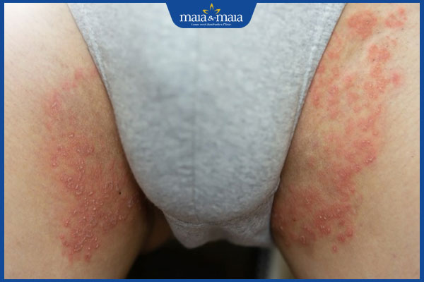 bẹn nổi mụn nước