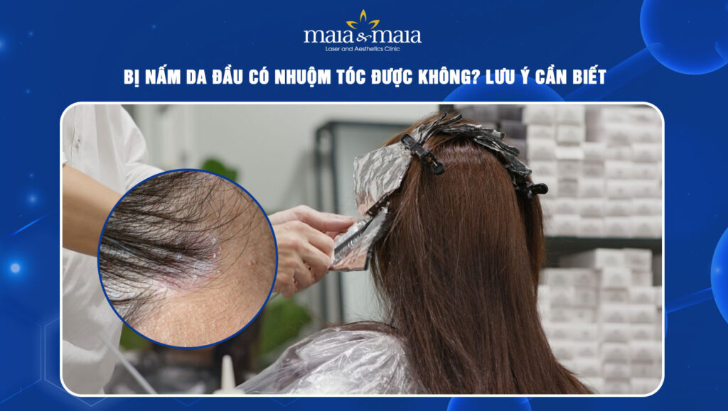 Bị nấm da đầu có nhuộm tóc được không